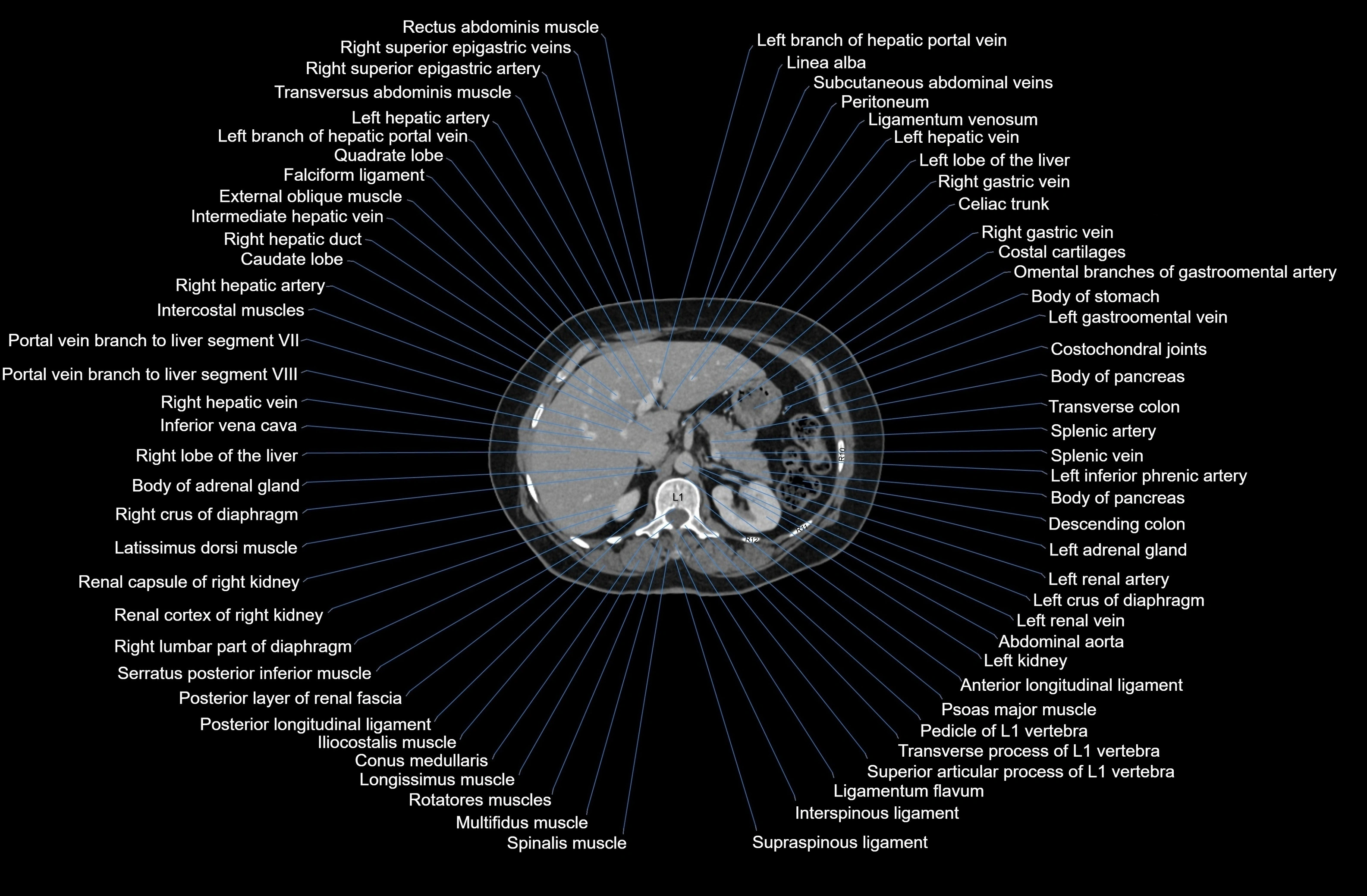 CT Abdomen axial cross sectional anatomy labelled radiology image-00025.webp